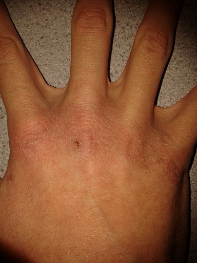 Photograph of the back of a hand with visible dry skin.